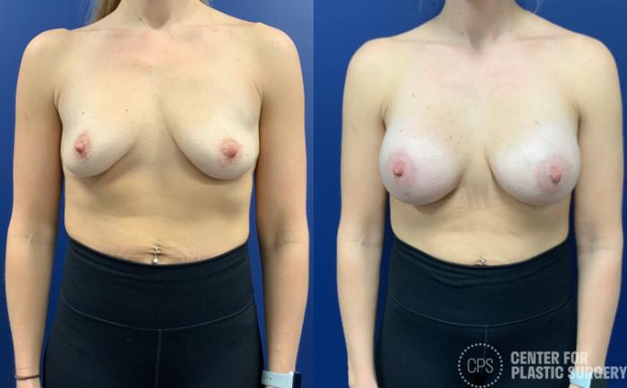 Breast Augmentation Case 198 Before & After F | Chevy Chase & Annandale, Washington D.C. Metropolitan Area | Center for Plastic Surgery