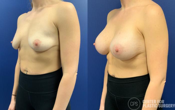 Breast Augmentation Case 198 Before & After Left Oblique | Chevy Chase & Annandale, Washington D.C. Metropolitan Area | Center for Plastic Surgery