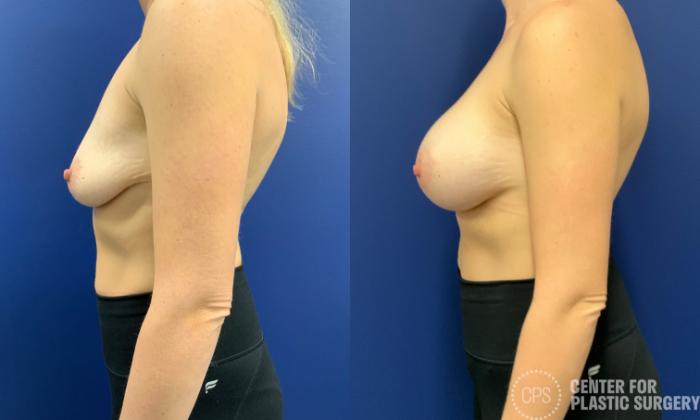 Breast Augmentation Case 198 Before & After Left Side | Chevy Chase & Annandale, Washington D.C. Metropolitan Area | Center for Plastic Surgery