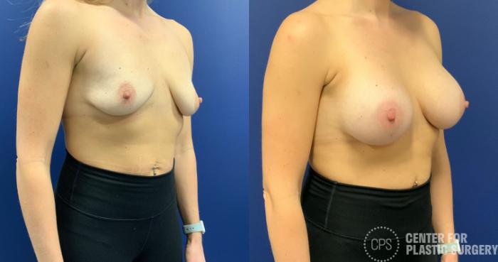 Breast Augmentation Case 198 Before & After Right Oblique | Chevy Chase & Annandale, Washington D.C. Metropolitan Area | Center for Plastic Surgery