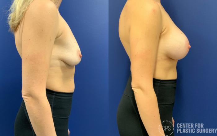 Breast Augmentation Case 198 Before & After Right Side | Chevy Chase & Annandale, Washington D.C. Metropolitan Area | Center for Plastic Surgery