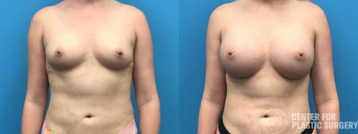 Breast Augmentation Case 219 Before & After Front | Chevy Chase & Annandale, Washington D.C. Metropolitan Area | Center for Plastic Surgery