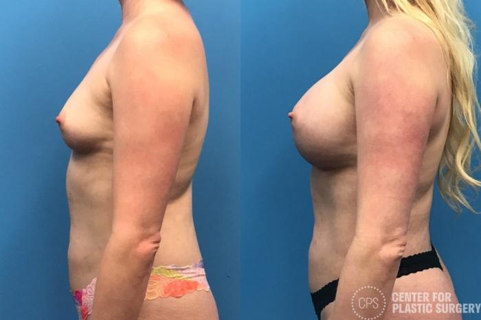 Breast Augmentation Case 219 Before & After Left Side | Chevy Chase & Annandale, Washington D.C. Metropolitan Area | Center for Plastic Surgery