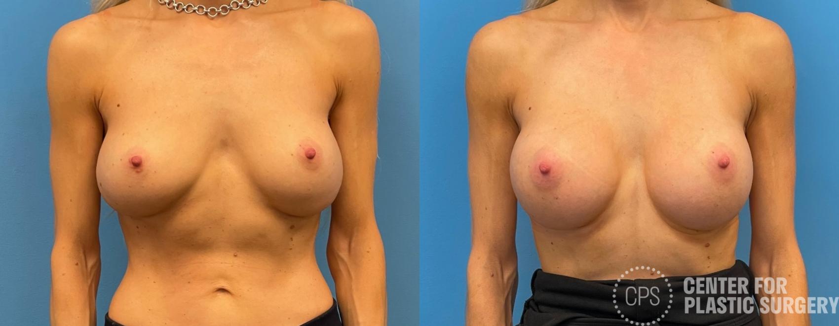 Breast Augmentation Case 220 Before & After Front | Chevy Chase & Annandale, Washington D.C. Metropolitan Area | Center for Plastic Surgery