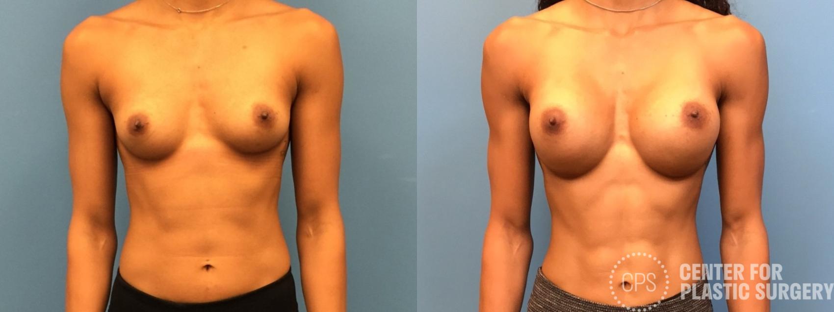 Breast Augmentation Case 221 Before & After Front | Chevy Chase & Annandale, Washington D.C. Metropolitan Area | Center for Plastic Surgery