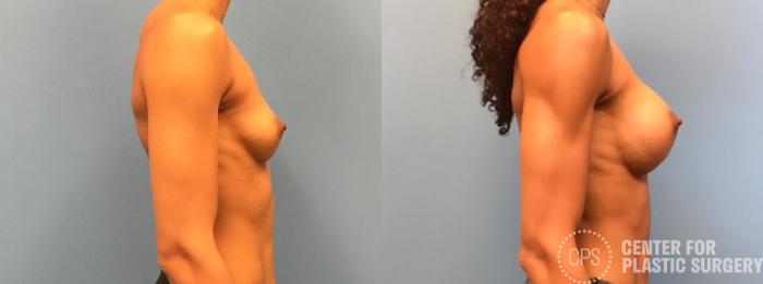 Breast Augmentation Case 221 Before & After Right Side | Chevy Chase & Annandale, Washington D.C. Metropolitan Area | Center for Plastic Surgery