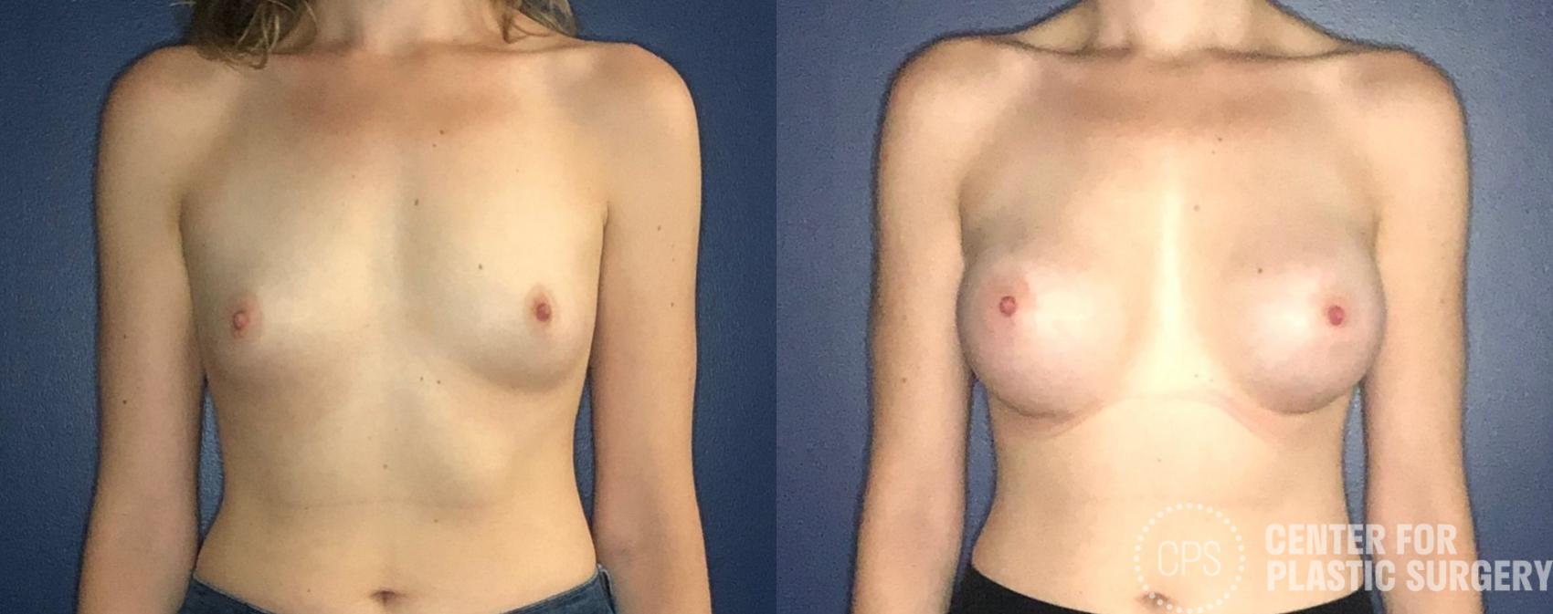 Breast Augmentation Case 222 Before & After Front | Chevy Chase & Annandale, Washington D.C. Metropolitan Area | Center for Plastic Surgery