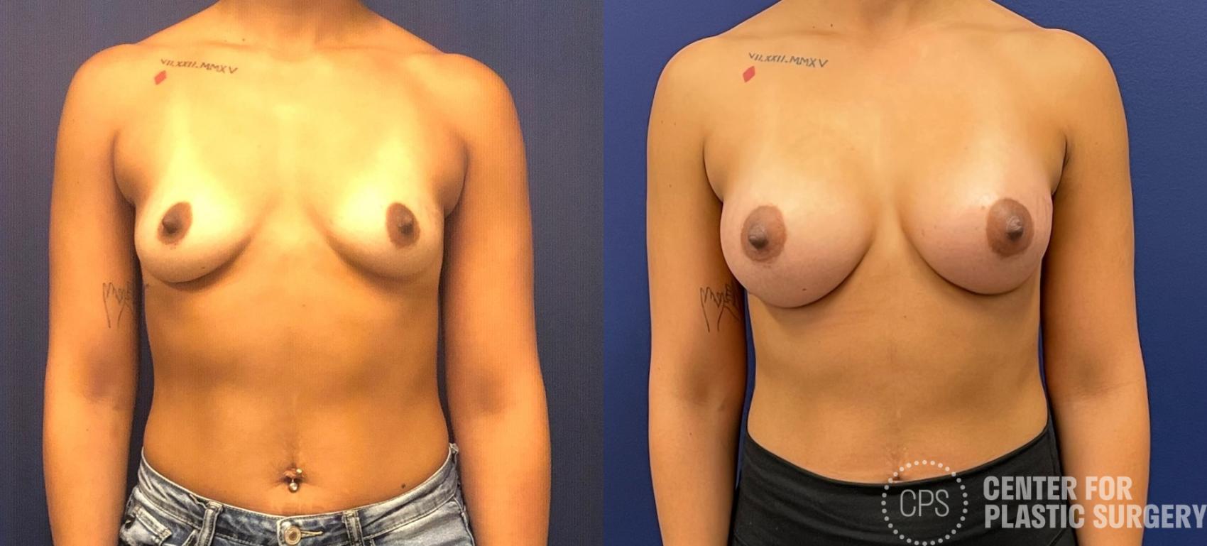 Breast Augmentation Case 223 Before & After Front | Chevy Chase & Annandale, Washington D.C. Metropolitan Area | Center for Plastic Surgery