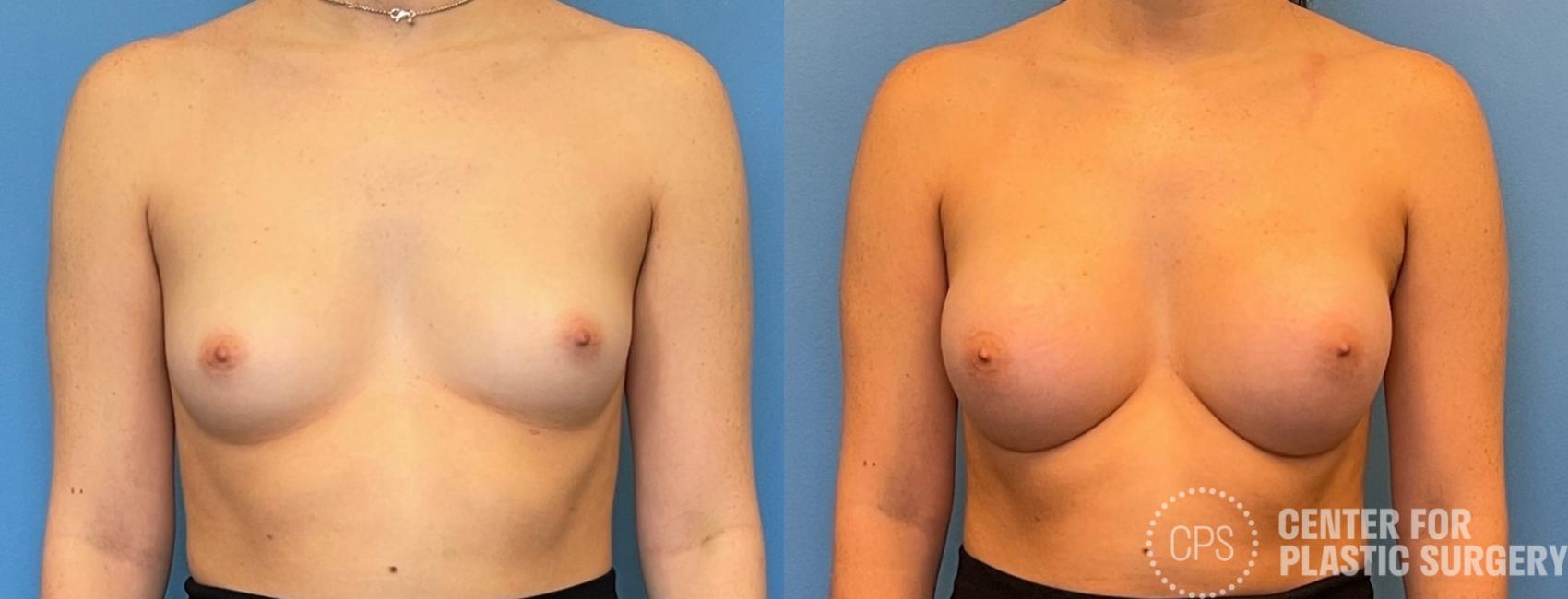 Breast Augmentation Case 224 Before & After Front | Chevy Chase & Annandale, Washington D.C. Metropolitan Area | Center for Plastic Surgery