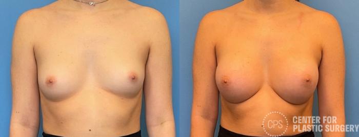 Breast Augmentation Case 224 Before & After Front | Chevy Chase & Annandale, Washington D.C. Metropolitan Area | Center for Plastic Surgery