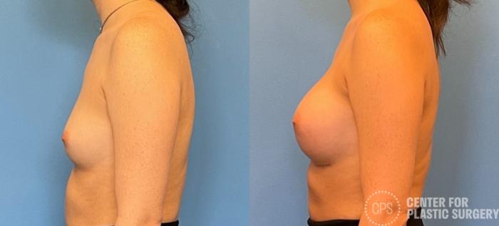 Breast Augmentation Case 224 Before & After Left Side | Chevy Chase & Annandale, Washington D.C. Metropolitan Area | Center for Plastic Surgery
