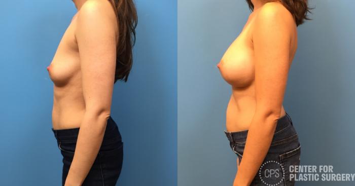 Breast Augmentation Case 226 Before & After Left Side | Chevy Chase & Annandale, Washington D.C. Metropolitan Area | Center for Plastic Surgery