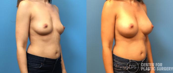 Breast Augmentation Case 226 Before & After Right Oblique | Chevy Chase & Annandale, Washington D.C. Metropolitan Area | Center for Plastic Surgery