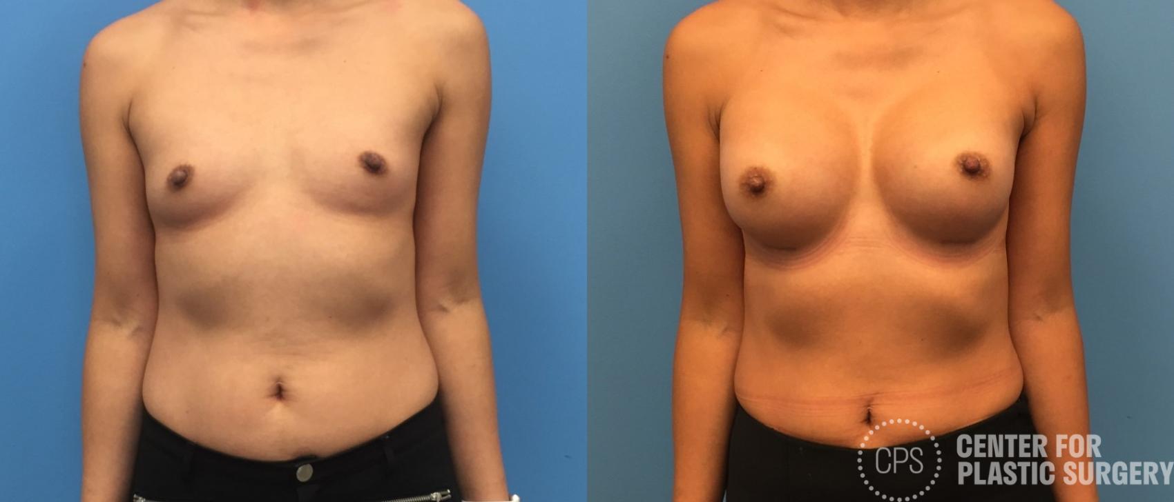 Breast Augmentation Case 227 Before & After Front | Annandale, Washington D.C. Metropolitan Area | Center for Plastic Surgery
