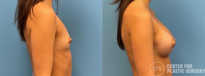 Breast Augmentation Case 228 Before & After Right Side | Chevy Chase & Annandale, Washington D.C. Metropolitan Area | Center for Plastic Surgery