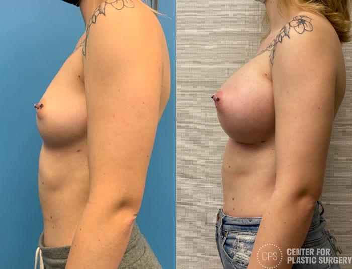 Breast Augmentation Case 322 Before & After Left Side | Chevy Chase & Annandale, Washington D.C. Metropolitan Area | Center for Plastic Surgery