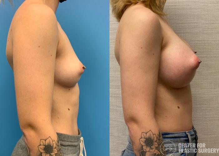 Breast Augmentation Case 322 Before & After Right Side | Chevy Chase & Annandale, Washington D.C. Metropolitan Area | Center for Plastic Surgery