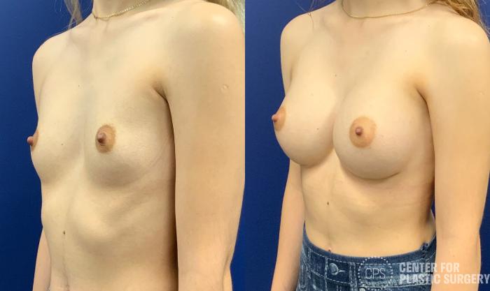 Breast Augmentation Case 330 Before & After Left Oblique | Chevy Chase & Annandale, Washington D.C. Metropolitan Area | Center for Plastic Surgery