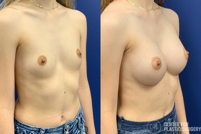 Breast Augmentation Case 330 Before & After Right Oblique | Chevy Chase & Annandale, Washington D.C. Metropolitan Area | Center for Plastic Surgery