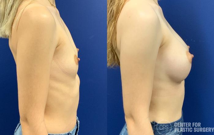 Breast Augmentation Case 330 Before & After Right Side | Chevy Chase & Annandale, Washington D.C. Metropolitan Area | Center for Plastic Surgery
