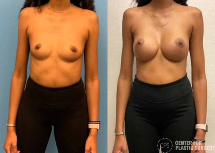 Breast Augmentation Case 331 Before & After Front | Chevy Chase & Annandale, Washington D.C. Metropolitan Area | Center for Plastic Surgery