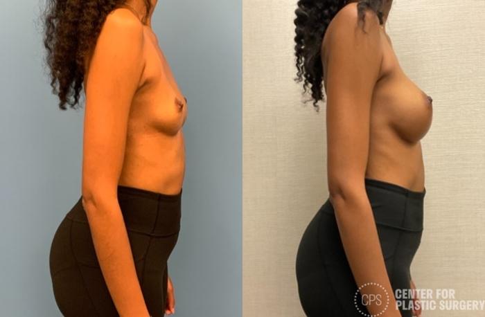 Breast Augmentation Case 331 Before & After Right Side | Chevy Chase & Annandale, Washington D.C. Metropolitan Area | Center for Plastic Surgery