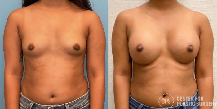 Breast Augmentation Case 332 Before & After Front | Chevy Chase & Annandale, Washington D.C. Metropolitan Area | Center for Plastic Surgery