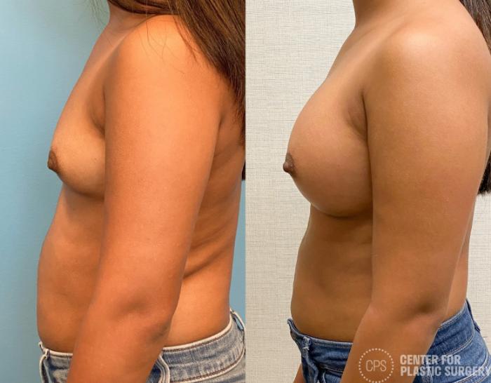 Breast Augmentation Case 332 Before & After Left Side | Chevy Chase & Annandale, Washington D.C. Metropolitan Area | Center for Plastic Surgery
