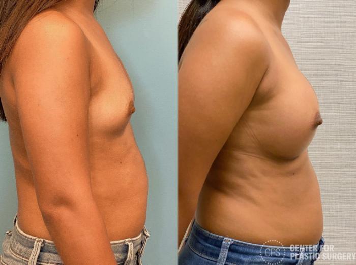 Breast Augmentation Case 332 Before & After Right Side | Chevy Chase & Annandale, Washington D.C. Metropolitan Area | Center for Plastic Surgery