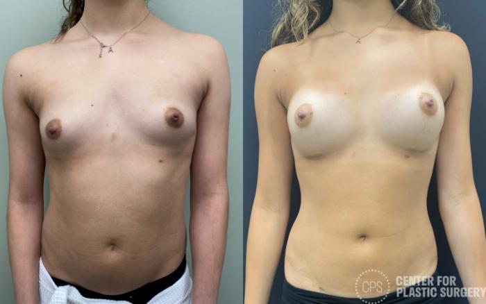 Breast Augmentation Case 346 Before & After Front | Chevy Chase & Annandale, Washington D.C. Metropolitan Area | Center for Plastic Surgery