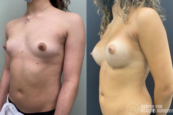 Breast Augmentation Case 346 Before & After Left Oblique | Chevy Chase & Annandale, Washington D.C. Metropolitan Area | Center for Plastic Surgery