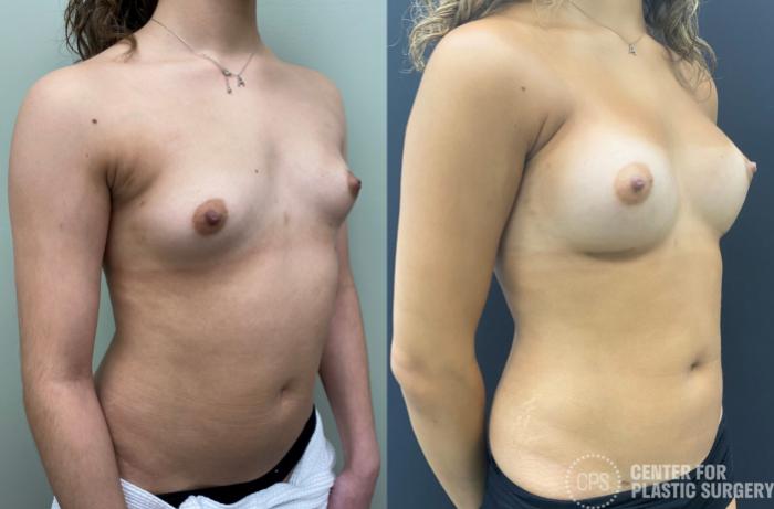 Breast Augmentation Case 346 Before & After Right Oblique | Chevy Chase & Annandale, Washington D.C. Metropolitan Area | Center for Plastic Surgery
