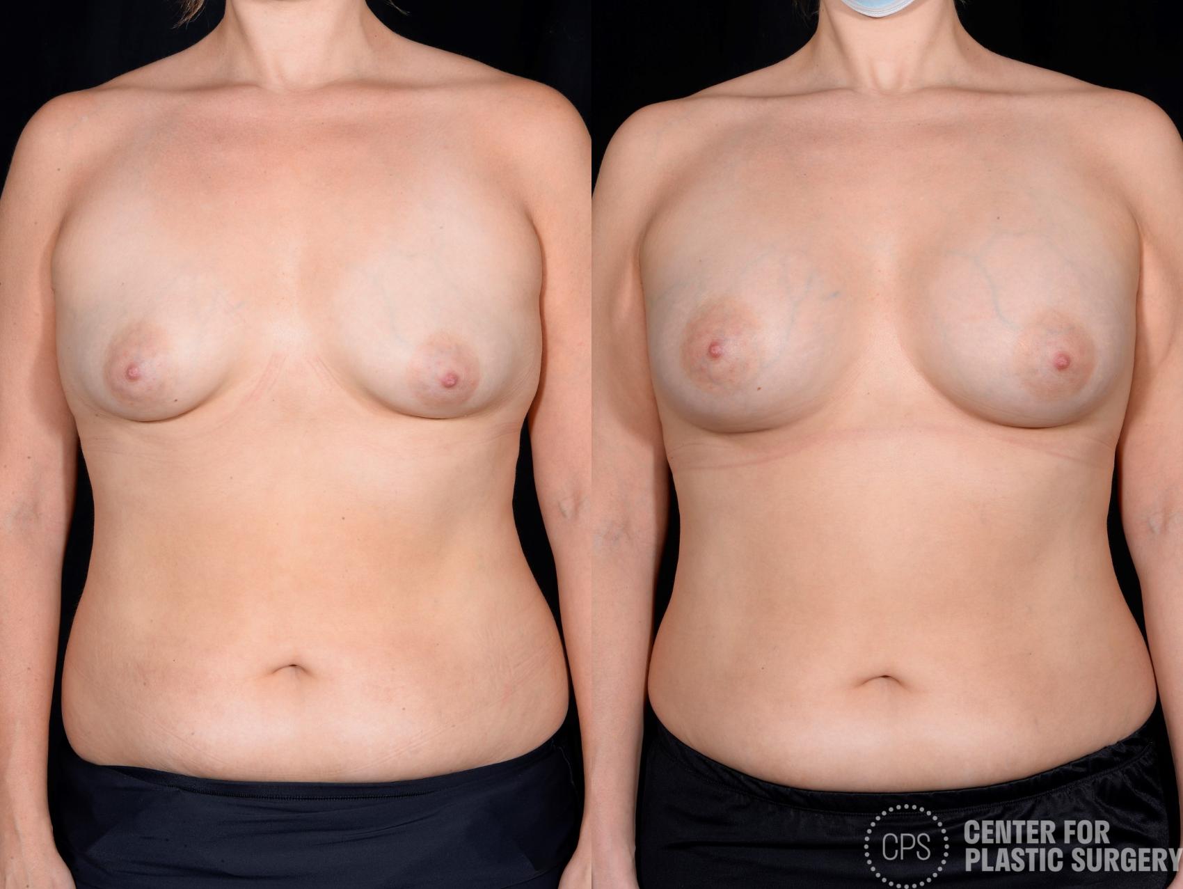 Breast Augmentation Case 349 Before & After Front | Chevy Chase & Annandale, Washington D.C. Metropolitan Area | Center for Plastic Surgery