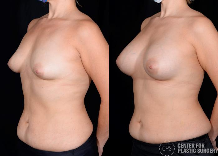 Breast Augmentation Case 349 Before & After Left Oblique | Chevy Chase & Annandale, Washington D.C. Metropolitan Area | Center for Plastic Surgery