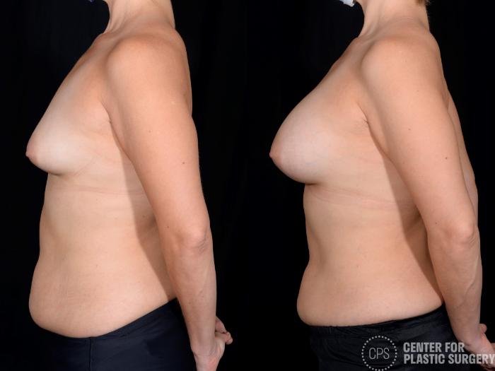 Breast Augmentation Case 349 Before & After Left Side | Chevy Chase & Annandale, Washington D.C. Metropolitan Area | Center for Plastic Surgery