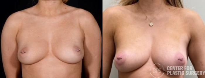 Breast Augmentation Case 350 Before & After Front | Chevy Chase & Annandale, Washington D.C. Metropolitan Area | Center for Plastic Surgery