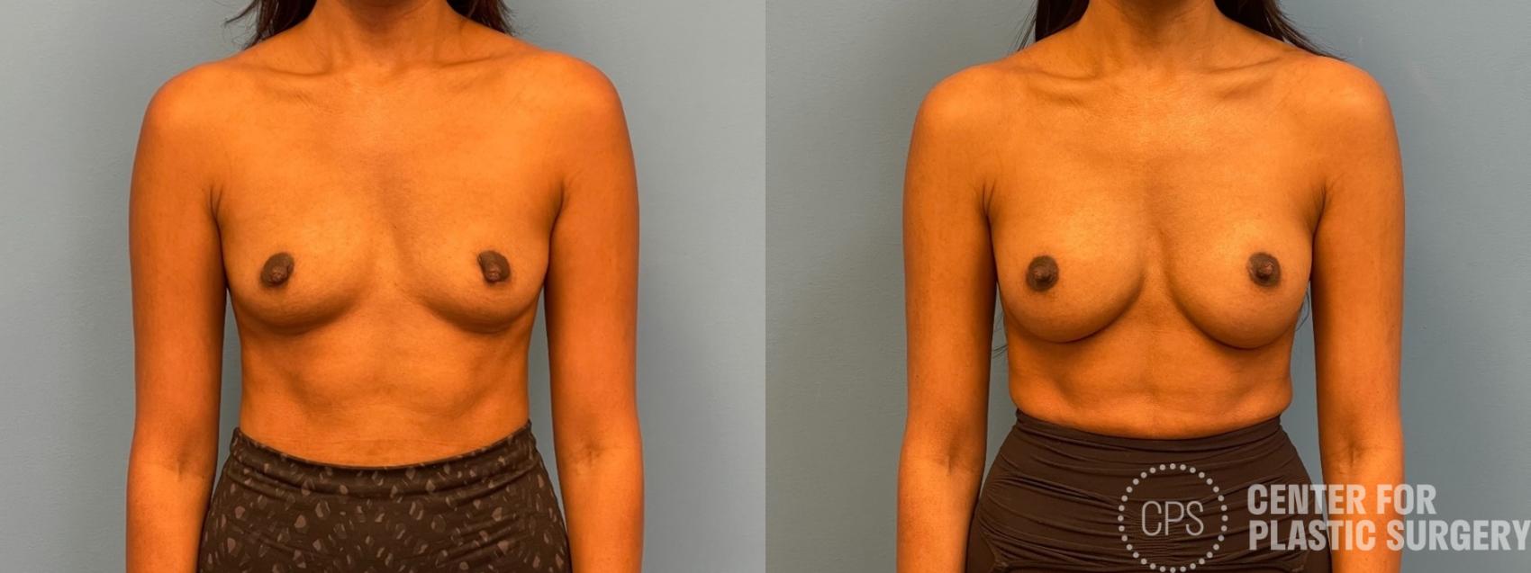 Breast Augmentation Case 387 Before & After Front | Chevy Chase & Annandale, Washington D.C. Metropolitan Area | Center for Plastic Surgery