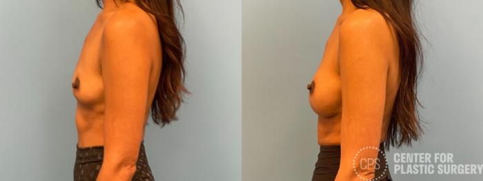 Breast Augmentation Case 387 Before & After Left Side | Chevy Chase & Annandale, Washington D.C. Metropolitan Area | Center for Plastic Surgery