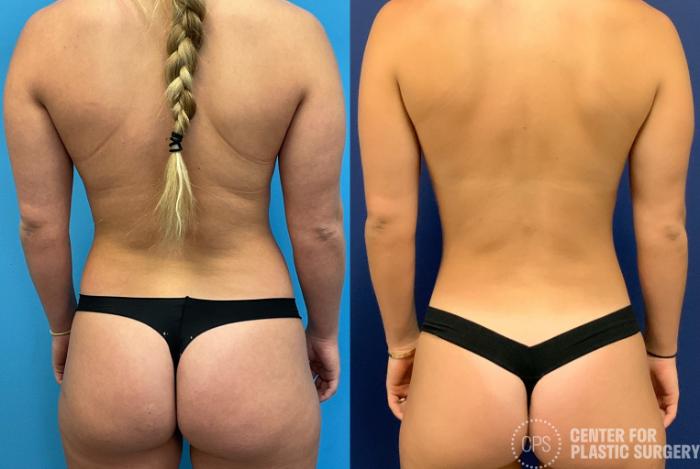 Breast Augmentation Case 397 Before & After Back | Chevy Chase & Annandale, Washington D.C. Metropolitan Area | Center for Plastic Surgery