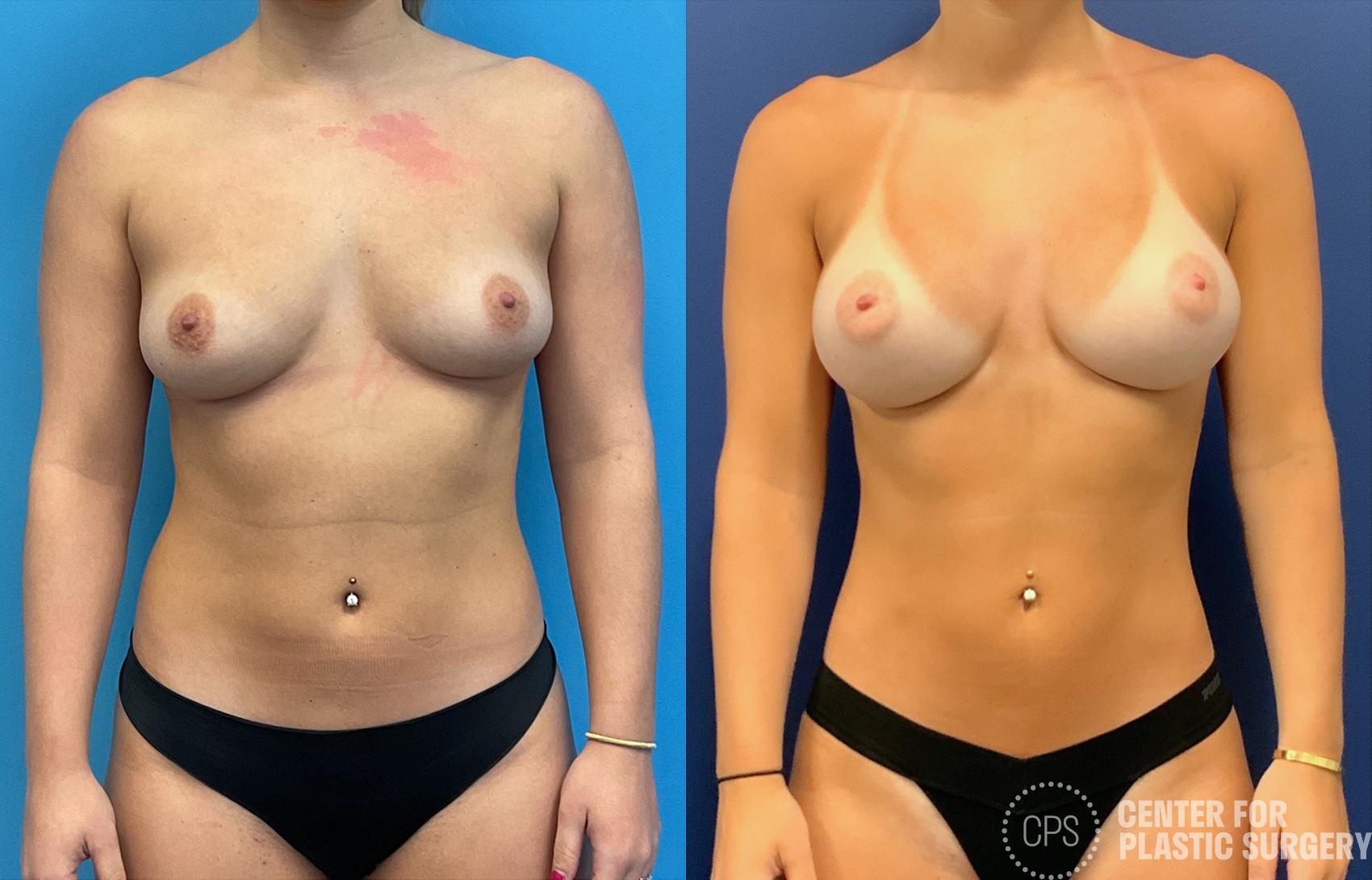Liposuction Case 397 Before & After Front | Chevy Chase & Annandale, Washington D.C. Metropolitan Area | Center for Plastic Surgery