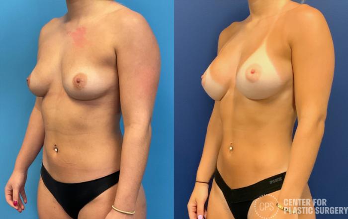 Breast Augmentation Case 397 Before & After Left Oblique | Chevy Chase & Annandale, Washington D.C. Metropolitan Area | Center for Plastic Surgery