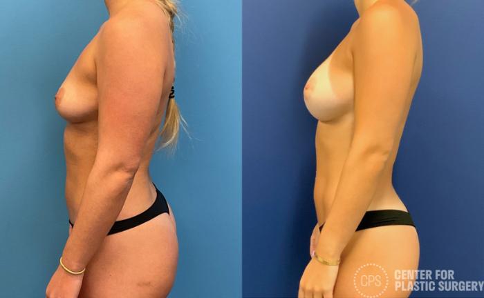 Liposuction Case 397 Before & After Left Side | Chevy Chase & Annandale, Washington D.C. Metropolitan Area | Center for Plastic Surgery