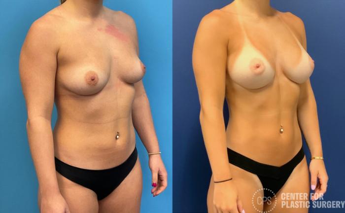 Breast Augmentation Case 397 Before & After Right Oblique | Chevy Chase & Annandale, Washington D.C. Metropolitan Area | Center for Plastic Surgery