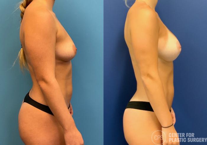 Breast Augmentation Case 397 Before & After Right Side | Chevy Chase & Annandale, Washington D.C. Metropolitan Area | Center for Plastic Surgery