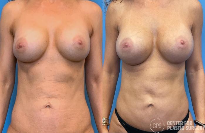 Breast Augmentation Case 412 Before & After Front | Chevy Chase & Annandale, Washington D.C. Metropolitan Area | Center for Plastic Surgery