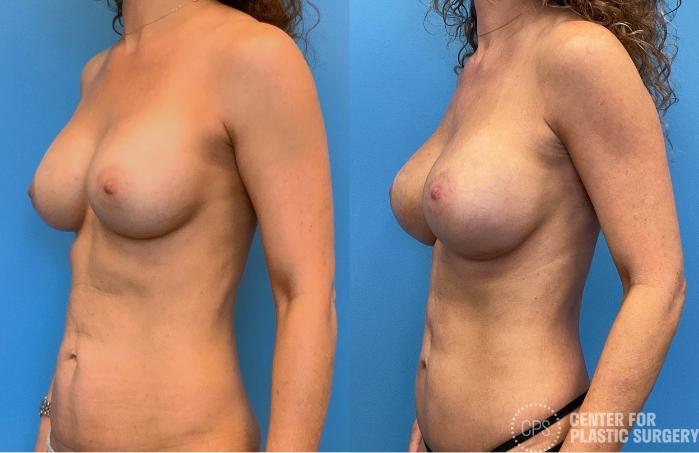 Breast Augmentation Case 412 Before & After Left Oblique | Chevy Chase & Annandale, Washington D.C. Metropolitan Area | Center for Plastic Surgery