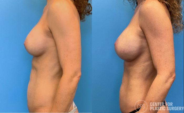 Breast Augmentation Case 412 Before & After Left Side | Chevy Chase & Annandale, Washington D.C. Metropolitan Area | Center for Plastic Surgery