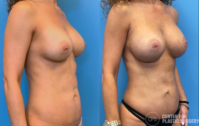 Breast Augmentation Case 412 Before & After Right Oblique | Chevy Chase & Annandale, Washington D.C. Metropolitan Area | Center for Plastic Surgery