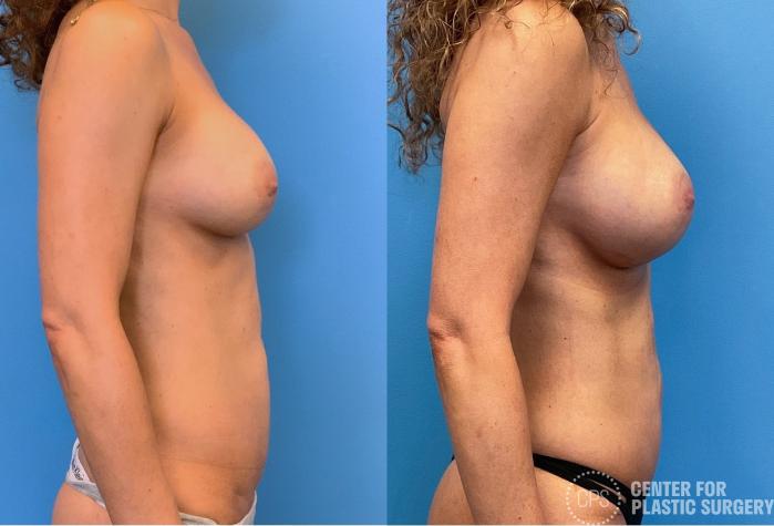 Breast Augmentation Case 412 Before & After Right Side | Chevy Chase & Annandale, Washington D.C. Metropolitan Area | Center for Plastic Surgery