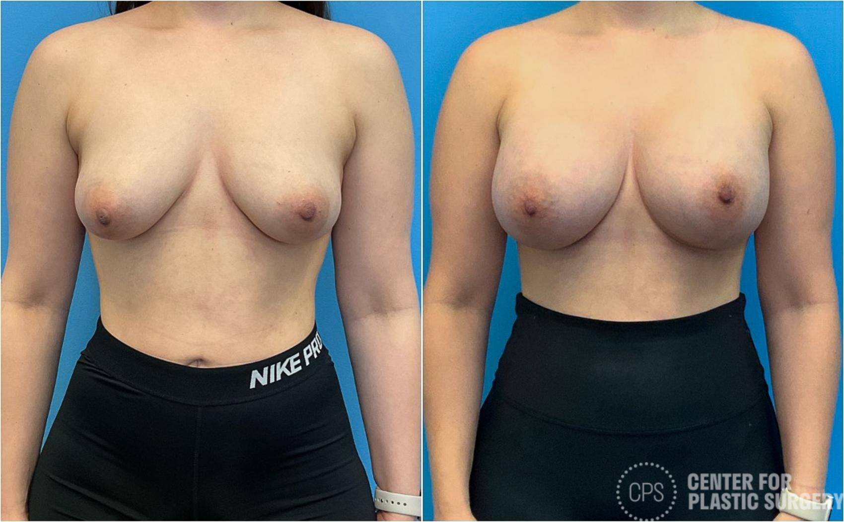 Breast Augmentation Case 417 Before & After Front | Chevy Chase & Annandale, Washington D.C. Metropolitan Area | Center for Plastic Surgery